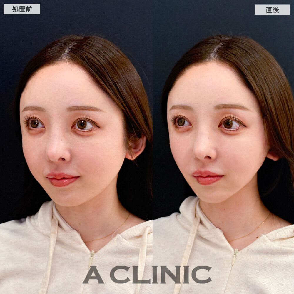 Aスレッドで顔の余白を無くすことでパーツが大きく見えるようになりました！こちら処置前と直後の症例です(20代女性)