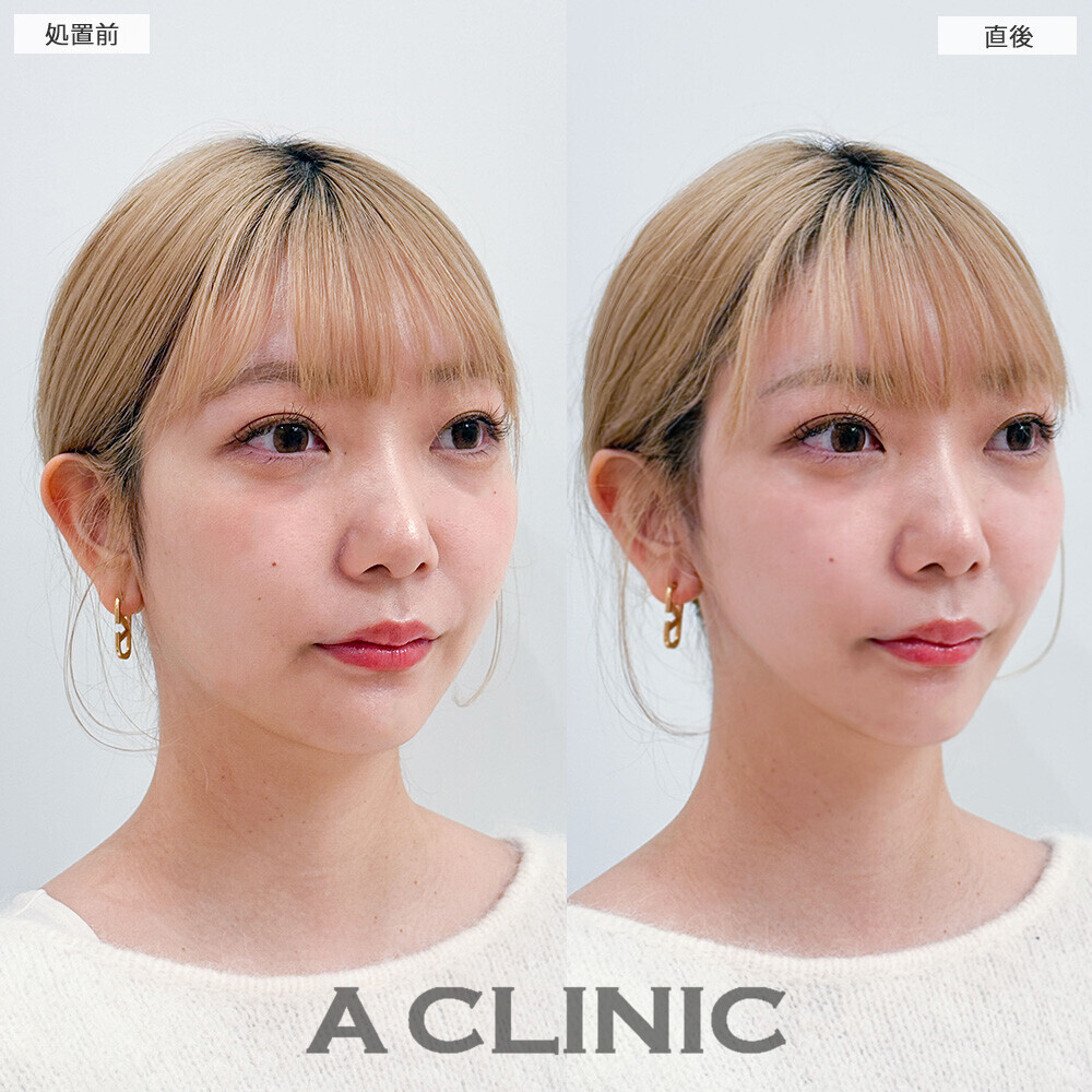 Aスレッドでリフトアップすることでより小顔になりました！こちら処置前と直後の症例です(20代女性)