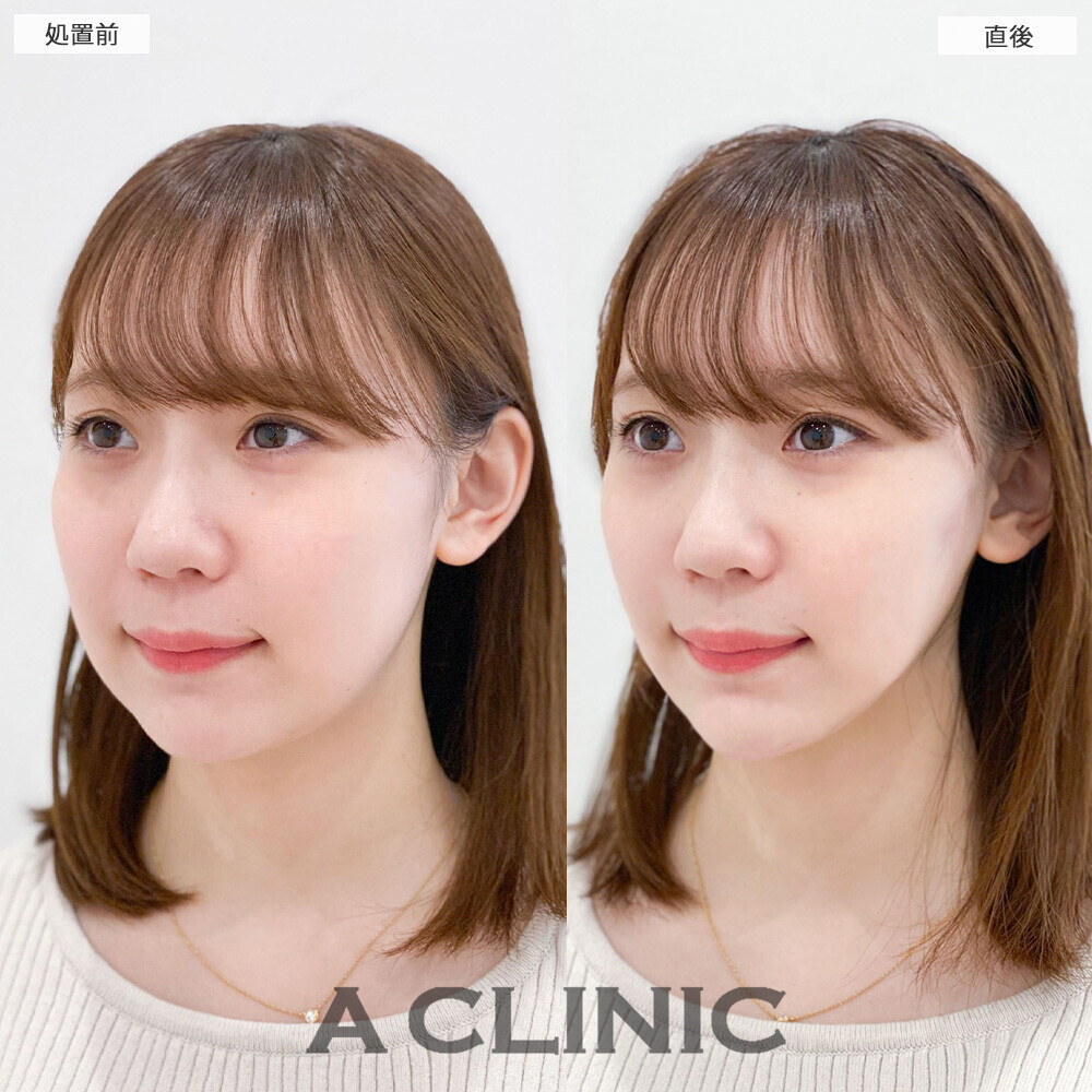 Aスレッドとあごへのヒアルロン酸注入で丸顔から卵型に変化！こちら処置前と直後の症例です(20代女性)