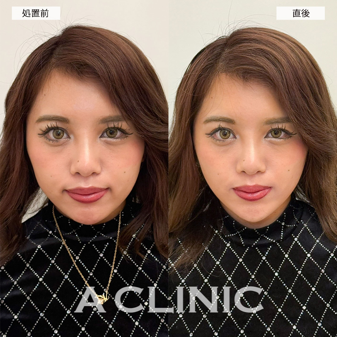 Aスレッドで直後からリフトアップし笑顔に自信が持てるようになりました！こちら処置前と直後の症例です(20代女性)