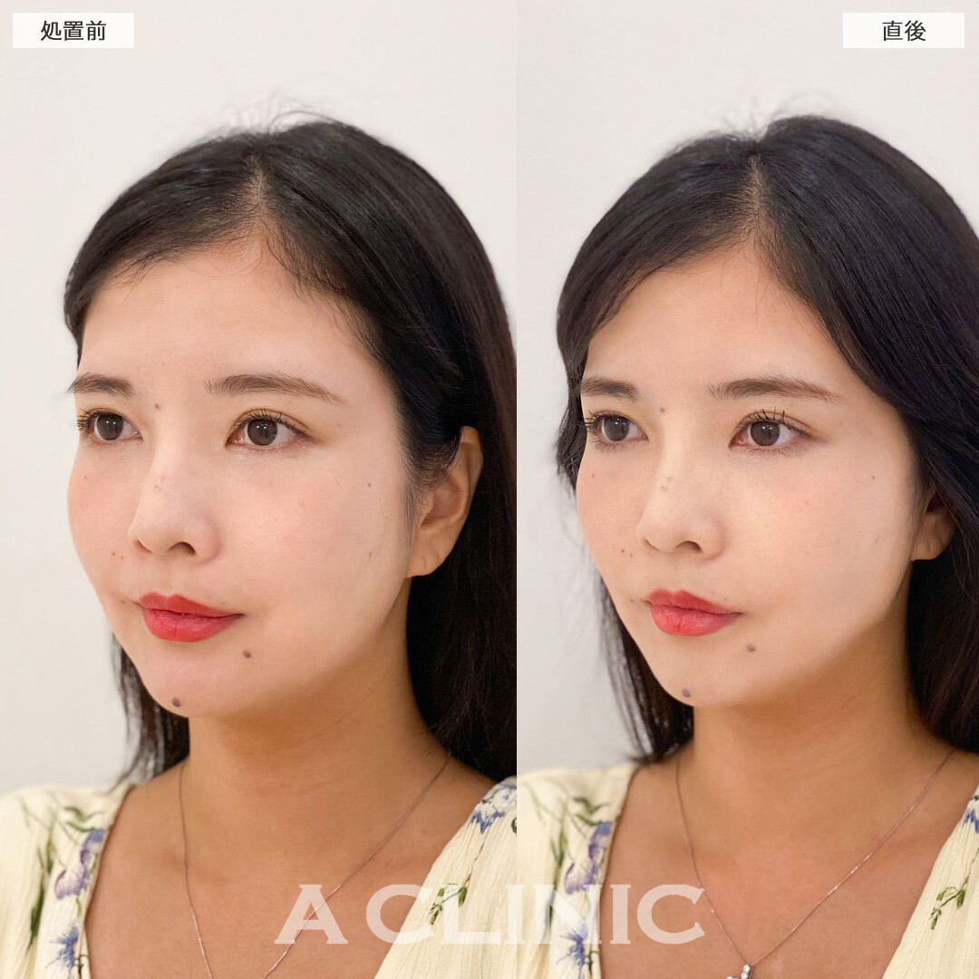 Aスレッドで口元のもたつきがなくなり、エッグフェイスへ！こちら処置前と直後の症例です(30代女性)