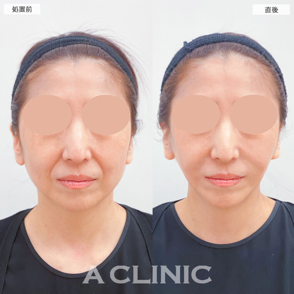 Aスレッドとヒアルロン酸注射(シワ)でほうれい線もなくなり若返りました！こちら処置前と直後の症例です(40代女性)