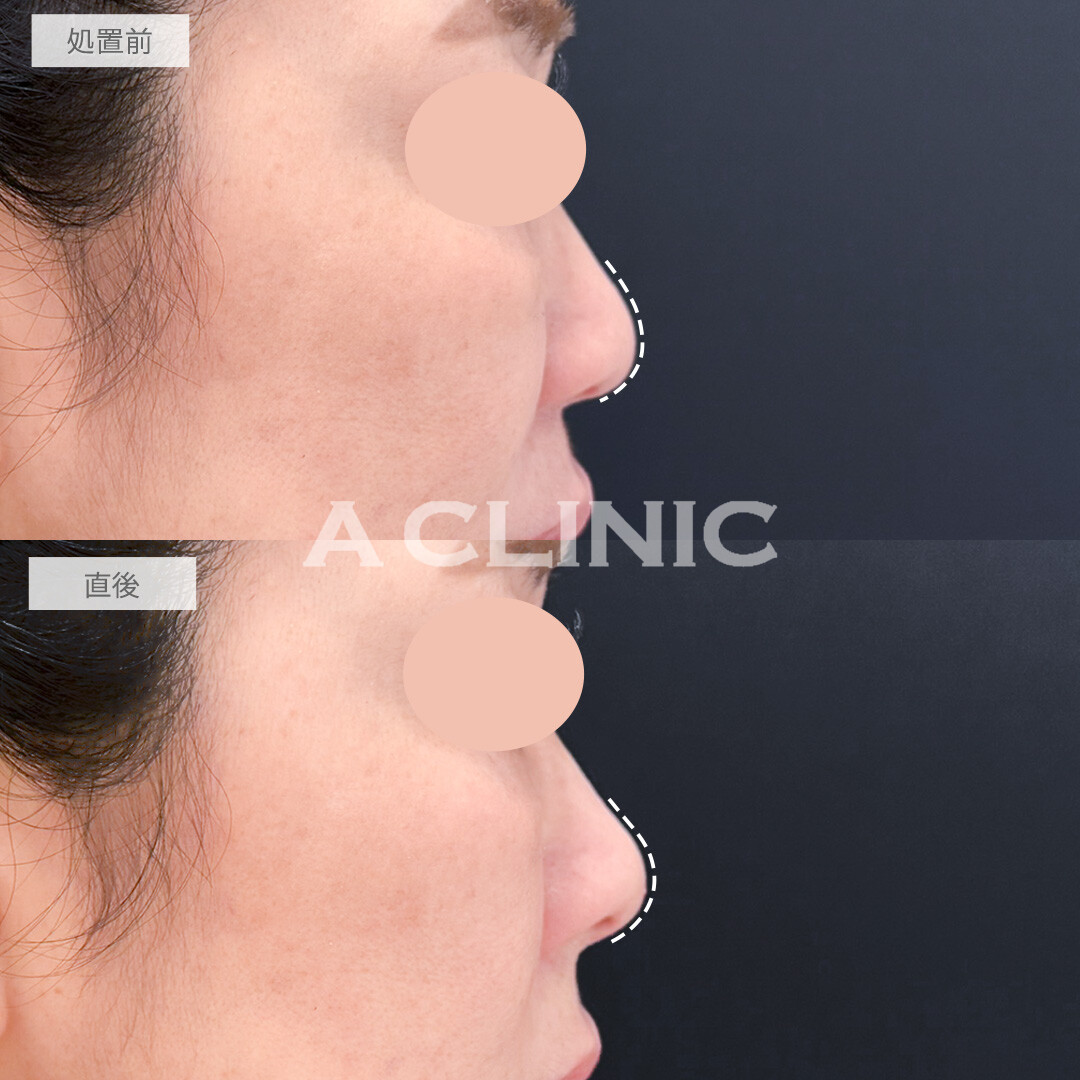 鼻ヒアルロン酸で鼻中隔延長し鼻の丸みを改善！処置前と直後の症例です(50代女性)