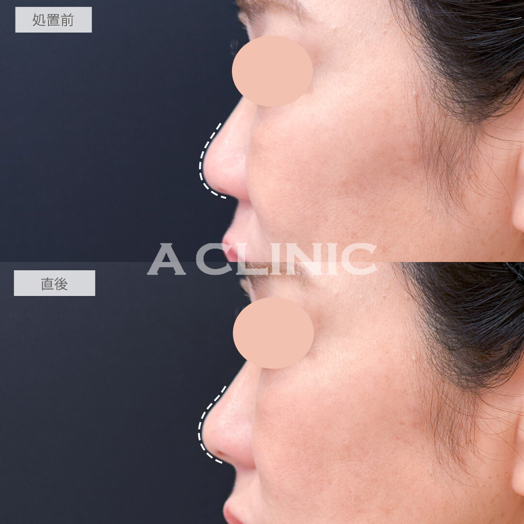 鼻ヒアルロン酸で鼻中隔延長し鼻の丸みを改善！処置前と直後の症例です(50代女性)