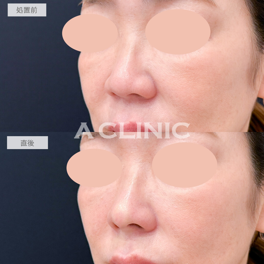 鼻ヒアルロン酸で鼻中隔延長し鼻の丸みを改善！処置前と直後の症例です(50代女性)