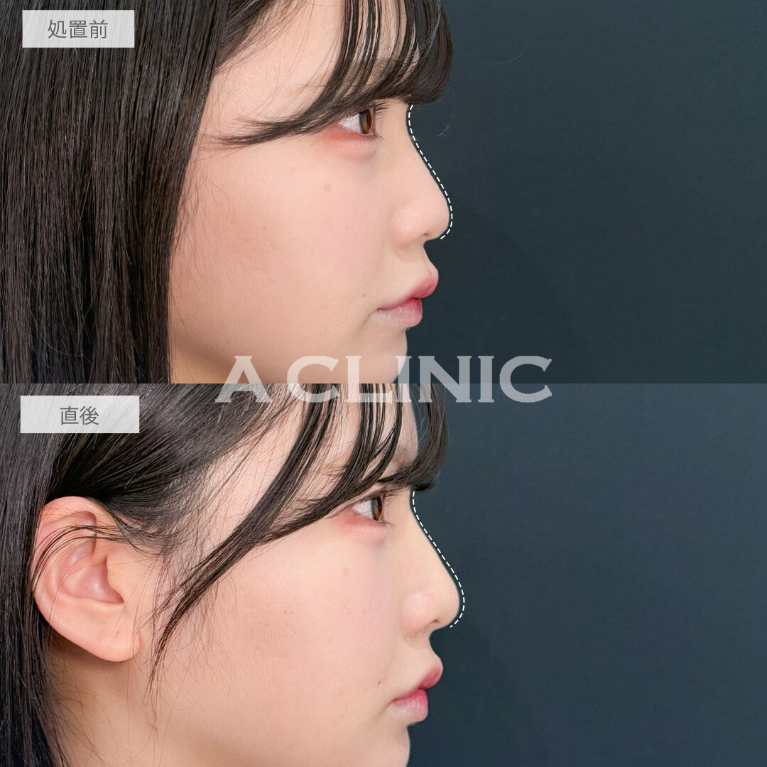 ヒアルロン酸カスタマイズメニューでパーツを際立たせて大人っぽい印象へ！処置前と直後の症例です(20代女性)