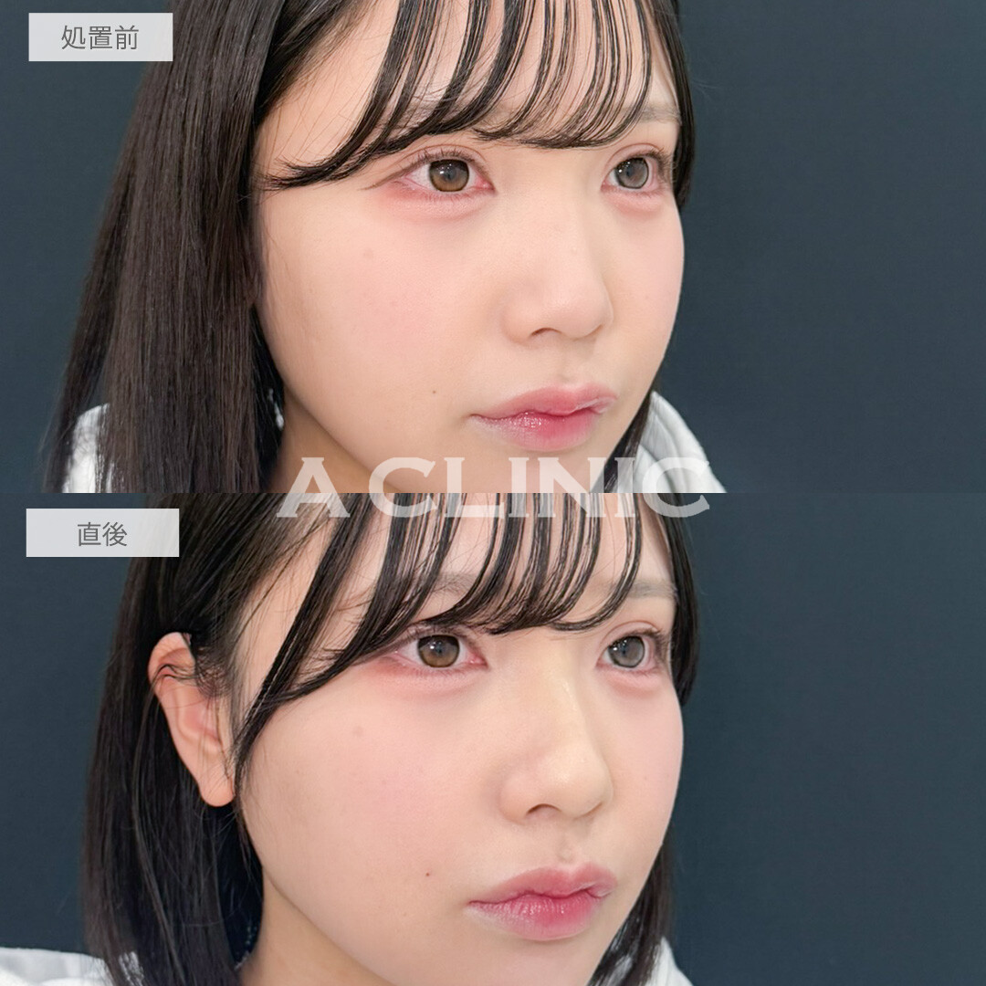 ヒアルロン酸カスタマイズメニューでパーツを際立たせて大人っぽい印象へ！処置前と直後の症例です(20代女性)