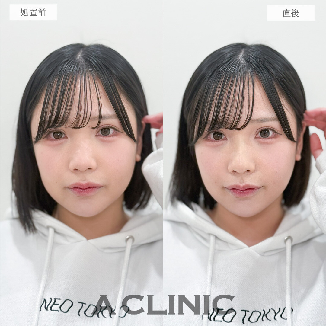 ヒアルロン酸カスタマイズメニューでパーツを際立たせて大人っぽい印象へ！処置前と直後の症例です(20代女性)
