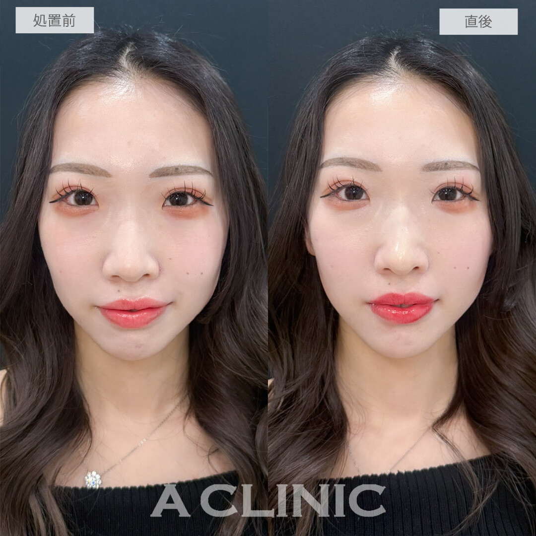 ヒアルロン酸カスタマイズメニューで輪郭や鼻の形もお好みで変えられます！処置前と直後の症例です(20代女性)