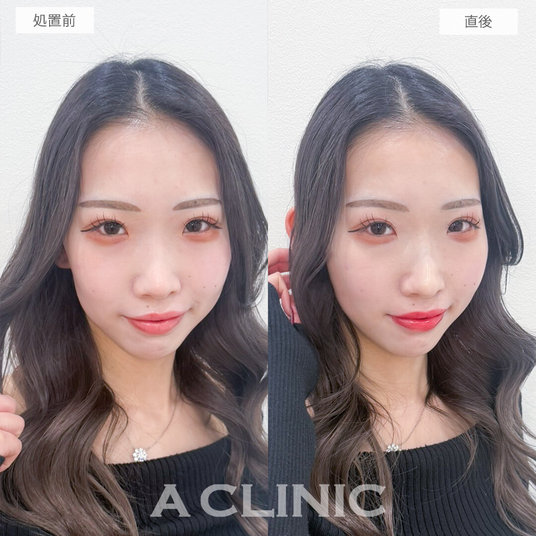 ヒアルロン酸カスタマイズメニューで輪郭や鼻の形もお好みで変えられます！処置前と直後の症例です(20代女性)