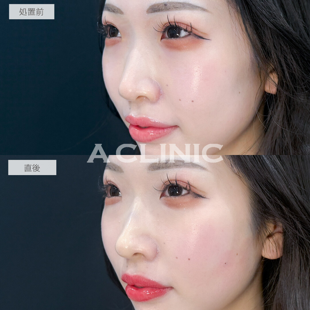 ヒアルロン酸カスタマイズメニューで輪郭や鼻の形もお好みで変えられます！処置前と直後の症例です(20代女性)