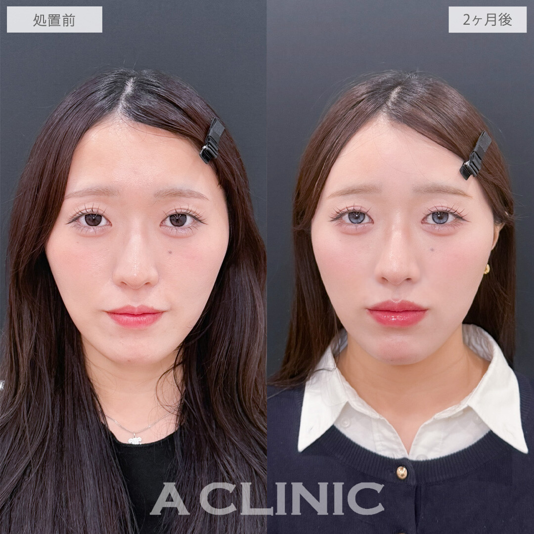 ヒアルロン酸カスタマイズメニューで立体感を出してアップデート！こちら処置前と2ヶ月後の症例です(20代女性)　