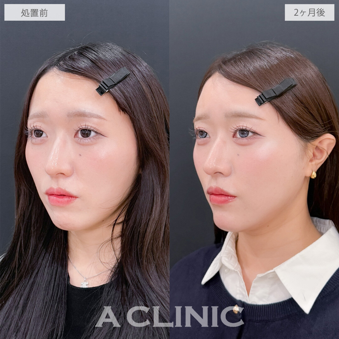 ヒアルロン酸カスタマイズメニューで立体感を出してアップデート！こちら処置前と2ヶ月後の症例です(20代女性)　