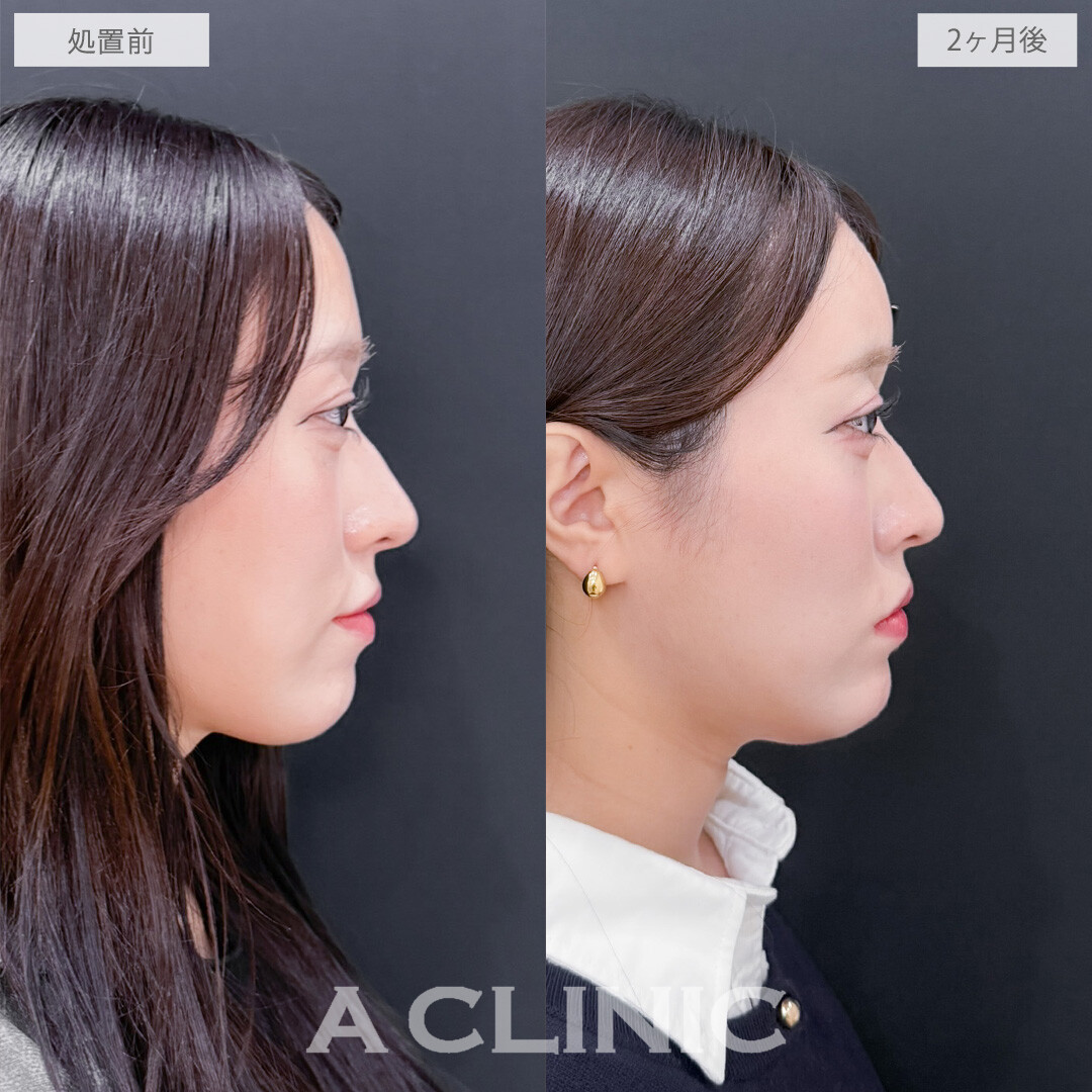 ヒアルロン酸カスタマイズメニューで立体感を出してアップデート！こちら処置前と2ヶ月後の症例です(20代女性)　
