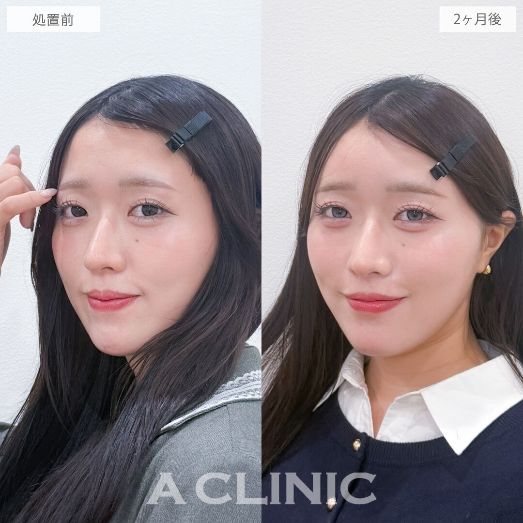 ヒアルロン酸カスタマイズメニューで立体感を出してアップデート！こちら処置前と2ヶ月後の症例です(20代女性)　