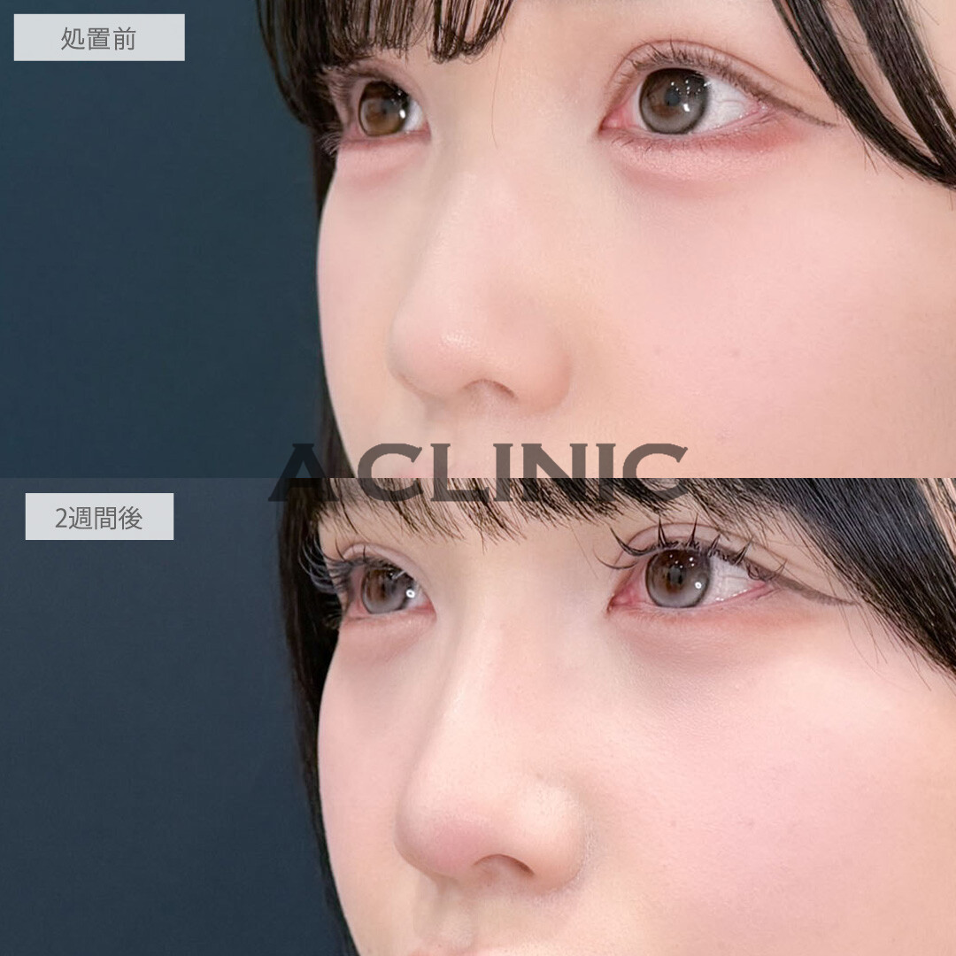 ヒアルロン酸カスタマイズメニューで大人っぽく印象を変えることが出来ました！こちら処置前と2週間後の症例です(20代女性)