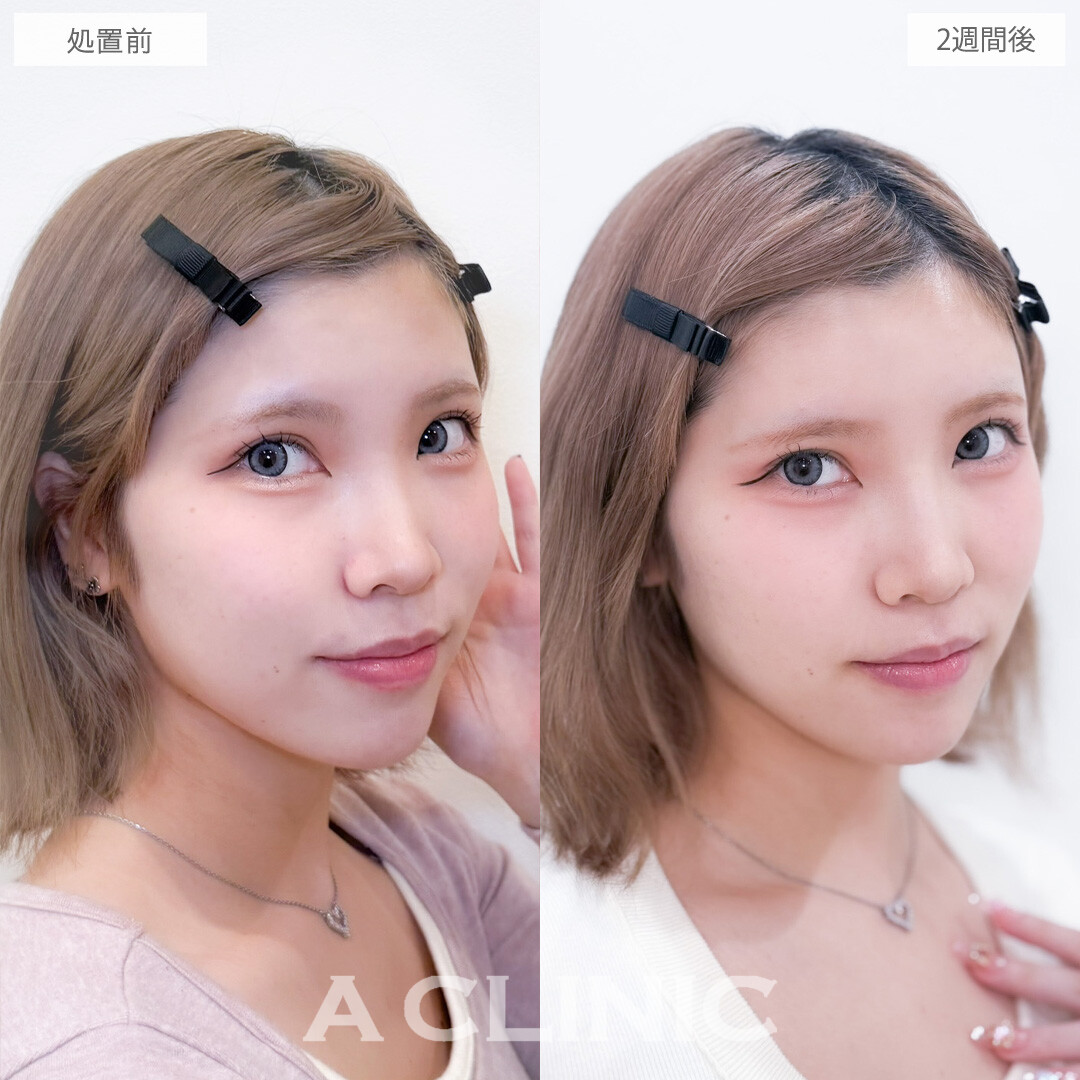 ヒアルロン酸カスタマイズメニューは注入だけでお顔の雰囲気をガラッと変えられます！こちら処置前と2週間後の症例です(20代女性)