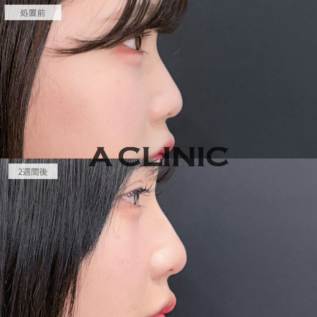ヒアルロン酸カスタマイズメニューで大人っぽく印象を変えることが出来ました！こちら処置前と2週間後の症例です(20代女性)