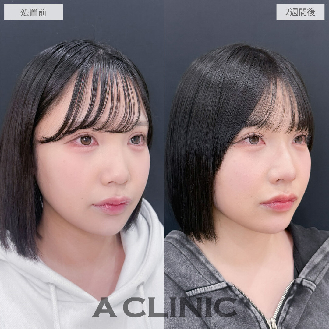 ヒアルロン酸カスタマイズメニューで大人っぽく印象を変えることが出来ました！こちら処置前と2週間後の症例です(20代女性)