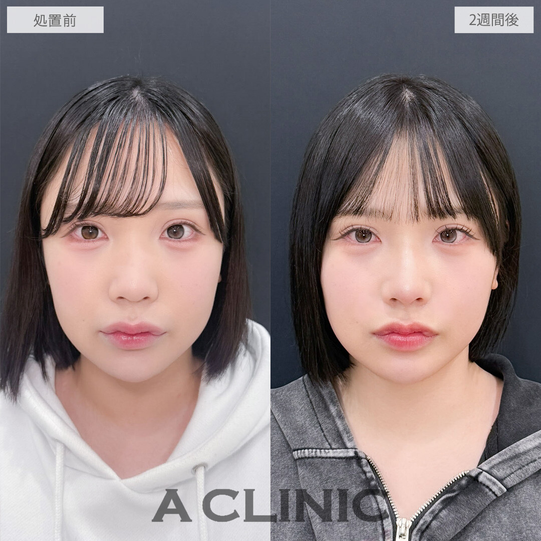 ヒアルロン酸カスタマイズメニューで大人っぽく印象を変えることが出来ました！こちら処置前と2週間後の症例です(20代女性)