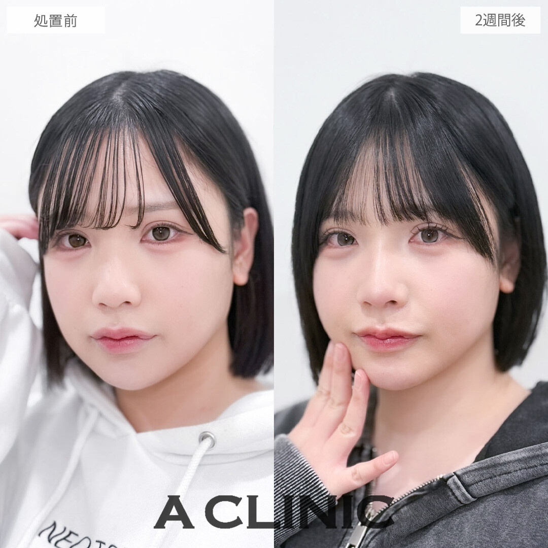 ヒアルロン酸カスタマイズメニューで大人っぽく印象を変えることが出来ました！こちら処置前と2週間後の症例です(20代女性)