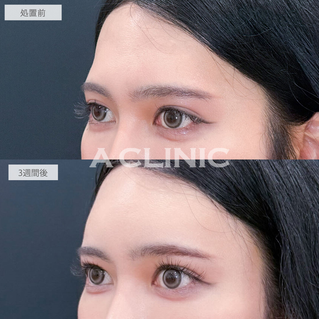 ヒアルロン酸カスタマイズメニューで丸みを帯びた優しい印象に！こちら処置前と3週間後の症例です(30代)