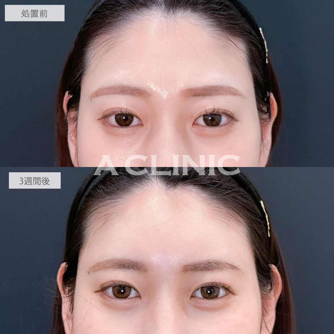 ヒアルロン酸カスタマイズメニューで凹み無くして丸みを持たせ優しい雰囲気に！こちら処置前と3週間後の症例です(30代女性)