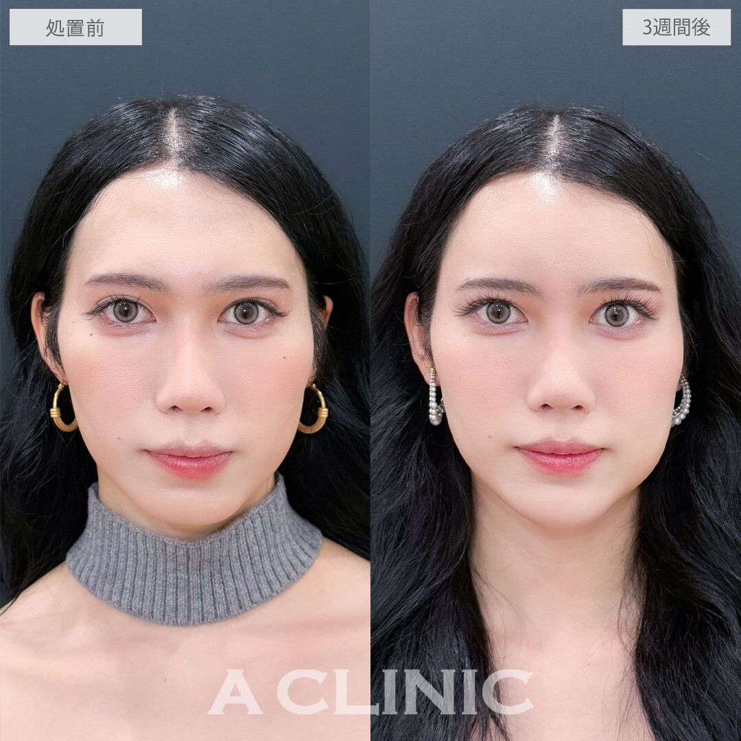 ヒアルロン酸カスタマイズメニューで丸みを帯びた優しい印象に！こちら処置前と3週間後の症例です(30代)