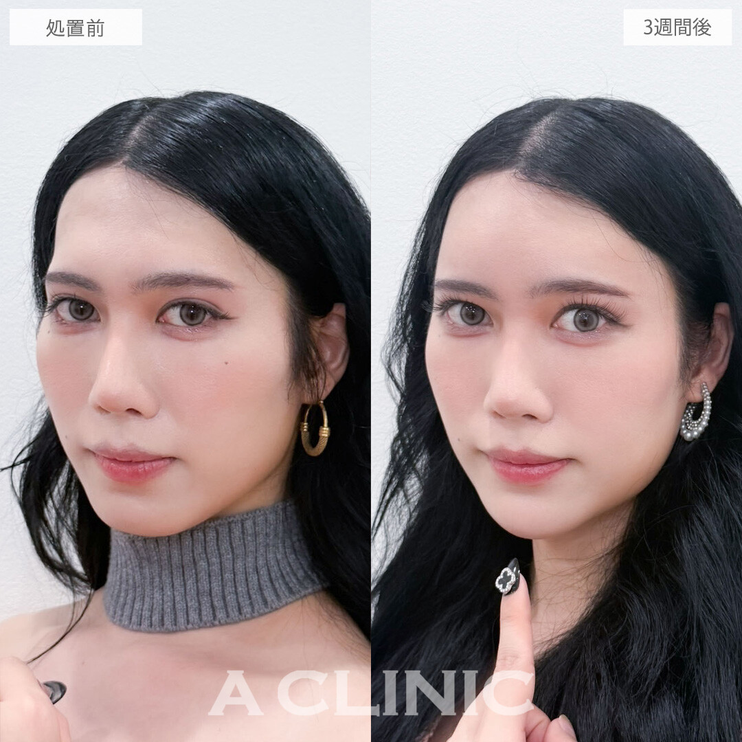 ヒアルロン酸カスタマイズメニューで丸みを帯びた優しい印象に！こちら処置前と3週間後の症例です(30代)