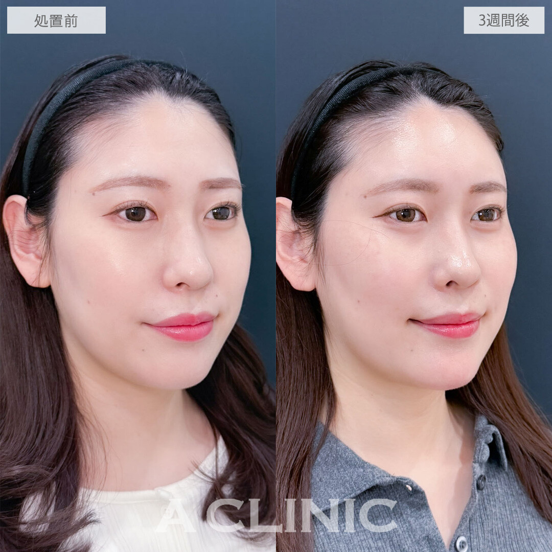 ヒアルロン酸カスタマイズメニューで凹み無くして丸みを持たせ優しい雰囲気に！こちら処置前と3週間後の症例です(30代女性)