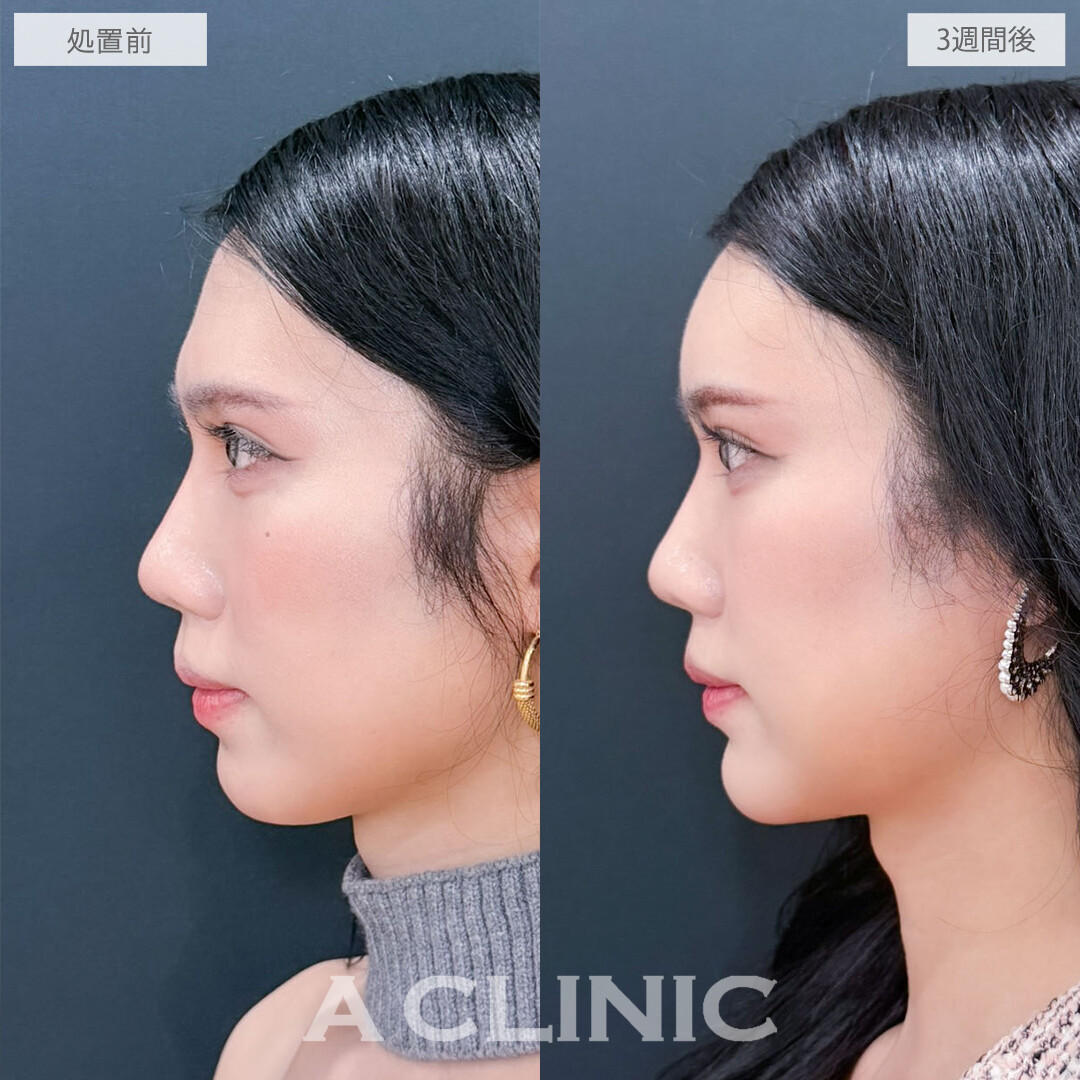 ヒアルロン酸カスタマイズメニューで丸みを帯びた優しい印象に！こちら処置前と3週間後の症例です(30代)