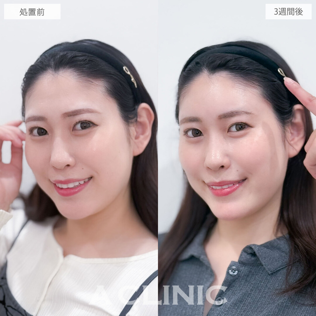 ヒアルロン酸カスタマイズメニューで凹み無くして丸みを持たせ優しい雰囲気に！こちら処置前と3週間後の症例です(30代女性)