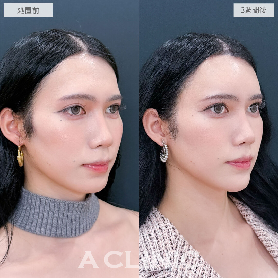 ヒアルロン酸カスタマイズメニューで丸みを帯びた優しい印象に！こちら処置前と3週間後の症例です(30代)
