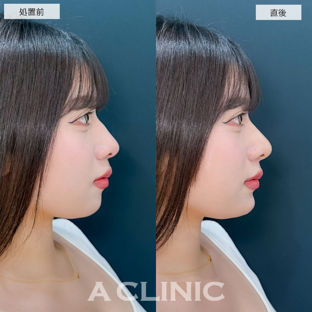 ヒアルロン酸カスタマイズメニューで直後からEラインが整い更に美人になりました！こちら処置前と直後の症例です(20代女性)