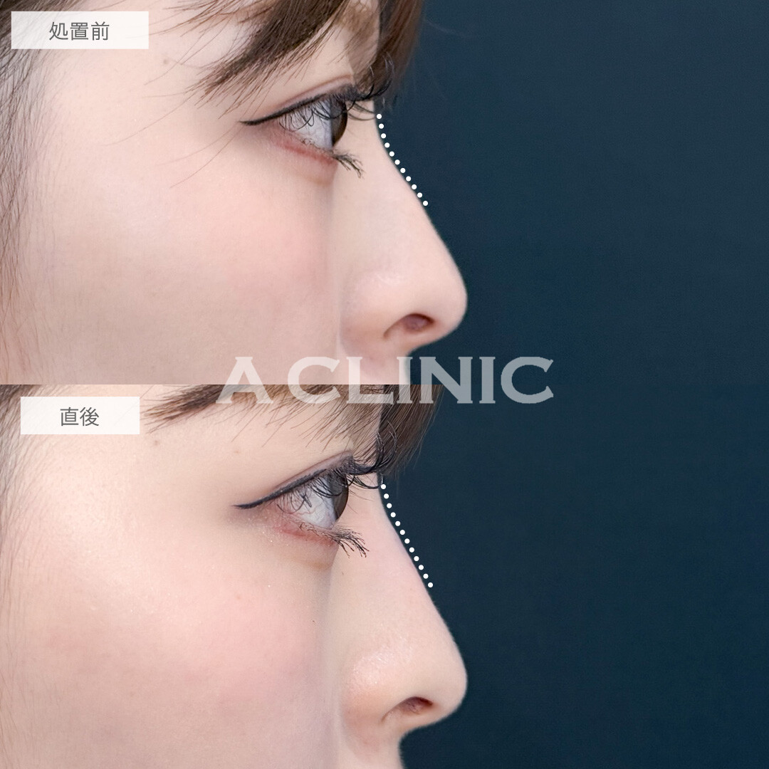 ヒアルロン酸カスタマイズメニューでお顔のお悩みを一気に解決！こちら処置前と直後の症例です(20代女性)