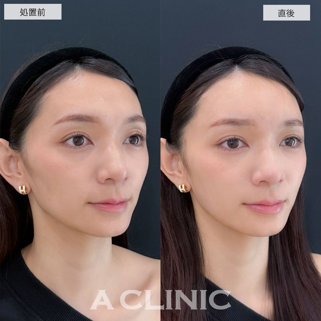 ヒアルロン酸カスタマイズメニューで凸凹を解消し女性らしい優しい雰囲気に！こちら処置前と直後の症例です(20代女性)