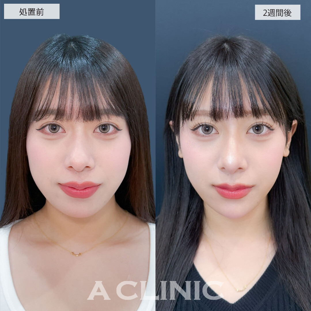 ヒアルロン酸カスタマイズメニューでどの角度からのお写真もより可愛くなりました！こちら処置前と2週間後の症例です(20代女性)