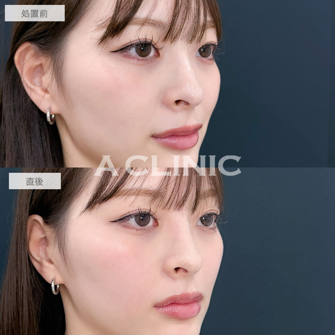 ヒアルロン酸カスタマイズメニューでお顔のお悩みを一気に解決！こちら処置前と直後の症例です(20代女性)