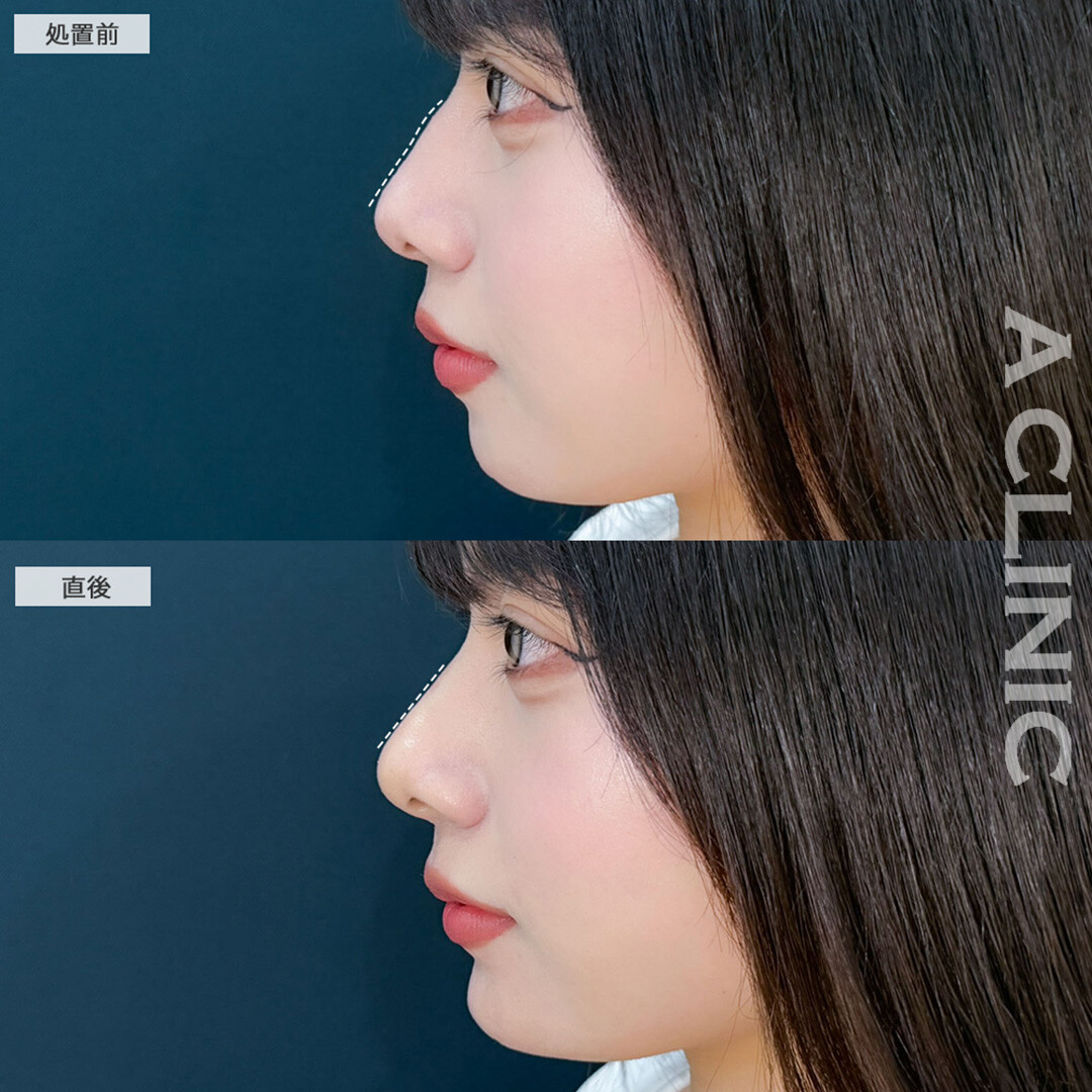ヒアルロン酸カスタマイズメニューで直後からEラインが整い更に美人になりました！こちら処置前と直後の症例です(20代女性)