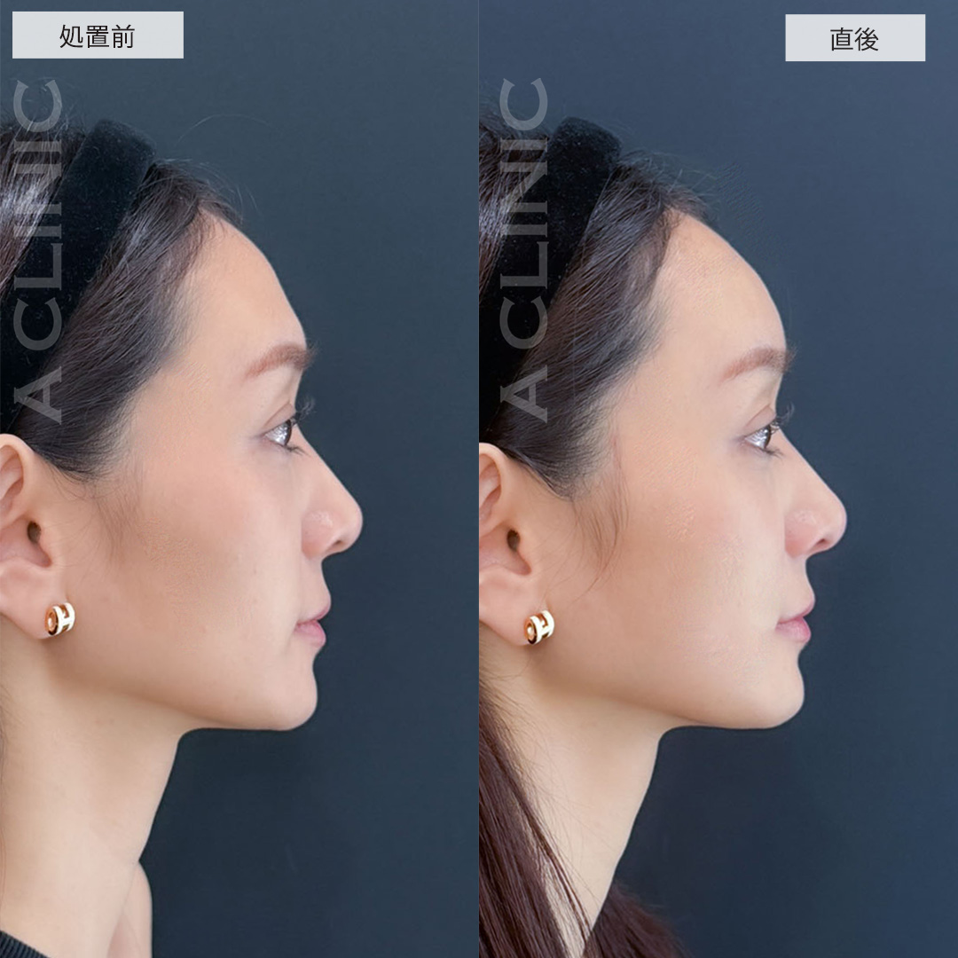 ヒアルロン酸カスタマイズメニューで凸凹を解消し女性らしい優しい雰囲気に！こちら処置前と直後の症例です(20代女性)