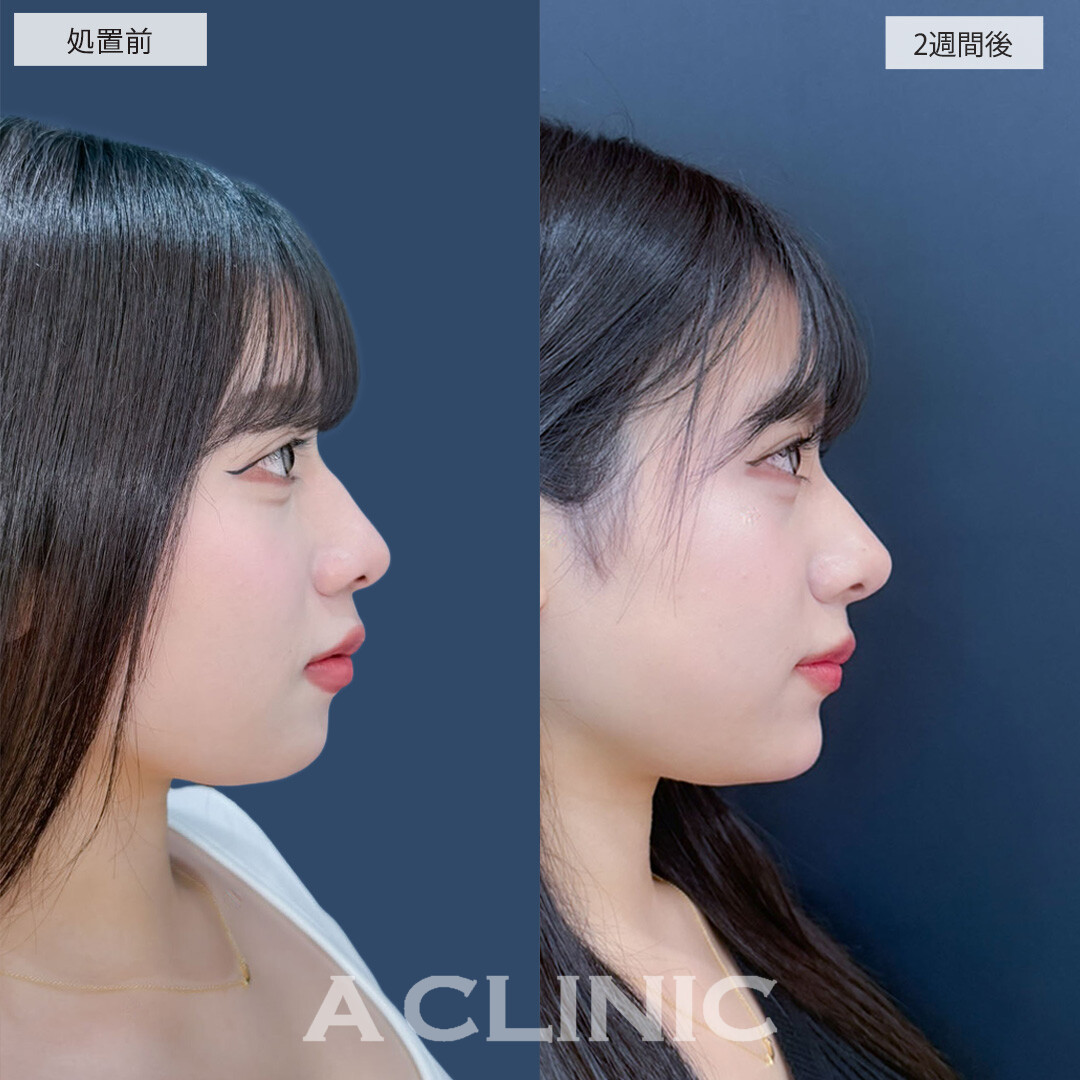 ヒアルロン酸カスタマイズメニューでどの角度からのお写真もより可愛くなりました！こちら処置前と2週間後の症例です(20代女性)