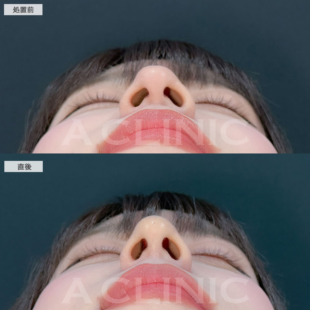 ヒアルロン酸カスタマイズメニューで直後からEラインが整い更に美人になりました！こちら処置前と直後の症例です(20代女性)
