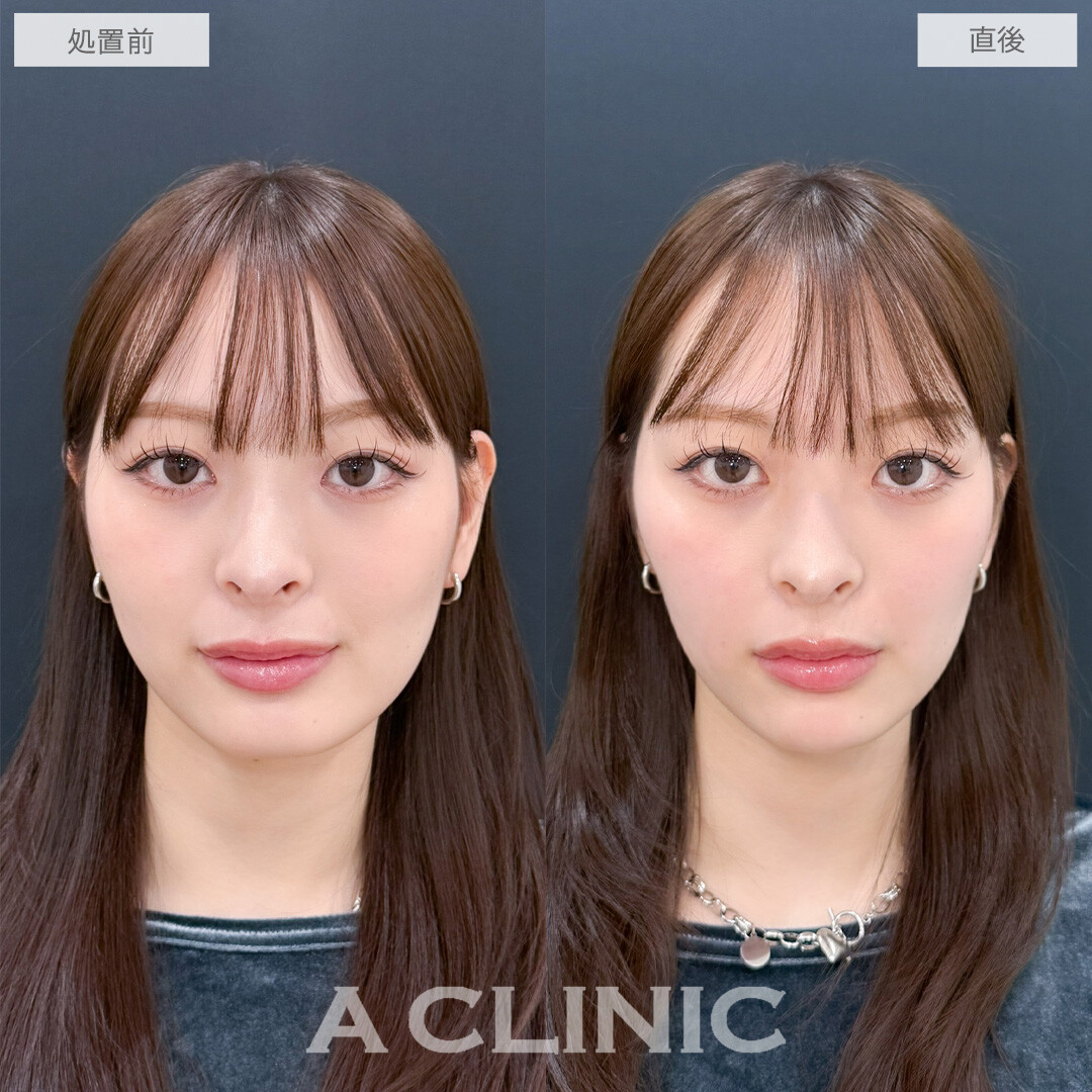ヒアルロン酸カスタマイズメニューでお顔のお悩みを一気に解決！こちら処置前と直後の症例です(20代女性)