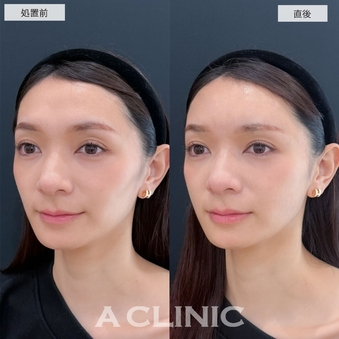 ヒアルロン酸カスタマイズメニューで凸凹を解消し女性らしい優しい雰囲気に！こちら処置前と直後の症例です(20代女性)
