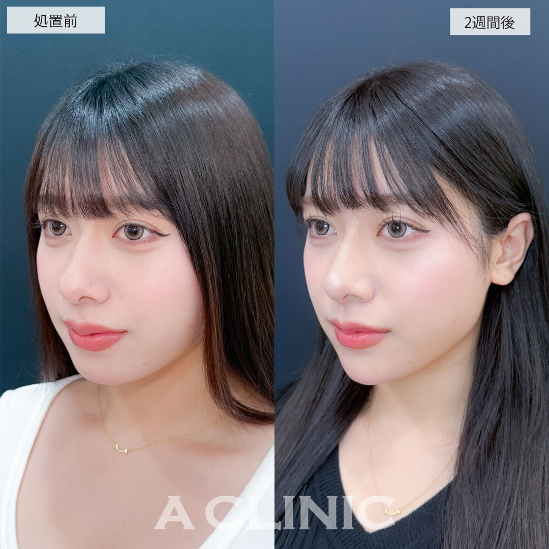 ヒアルロン酸カスタマイズメニューでどの角度からのお写真もより可愛くなりました！こちら処置前と2週間後の症例です(20代女性)