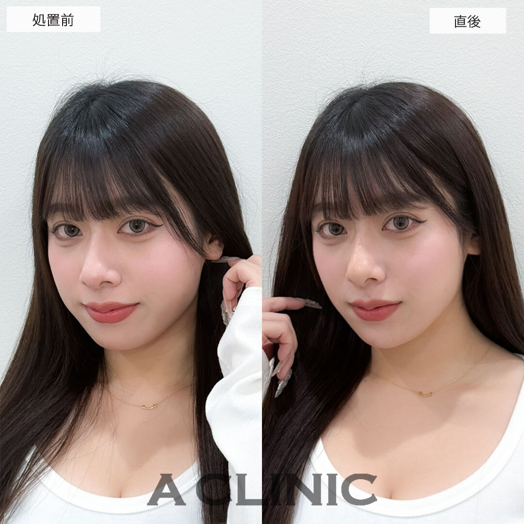 ヒアルロン酸カスタマイズメニューで直後からEラインが整い更に美人になりました！こちら処置前と直後の症例です(20代女性)