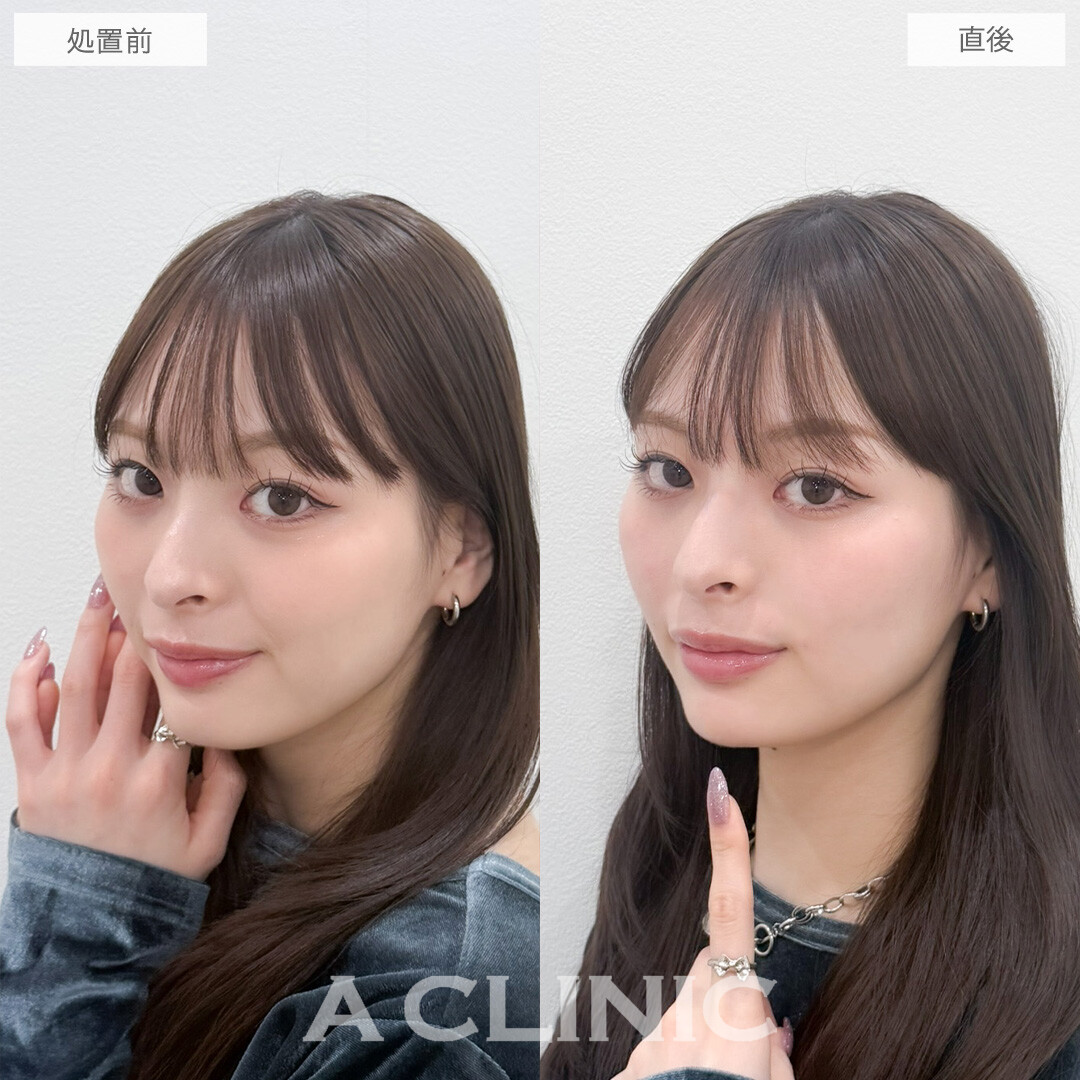 ヒアルロン酸カスタマイズメニューでお顔のお悩みを一気に解決！こちら処置前と直後の症例です(20代女性)