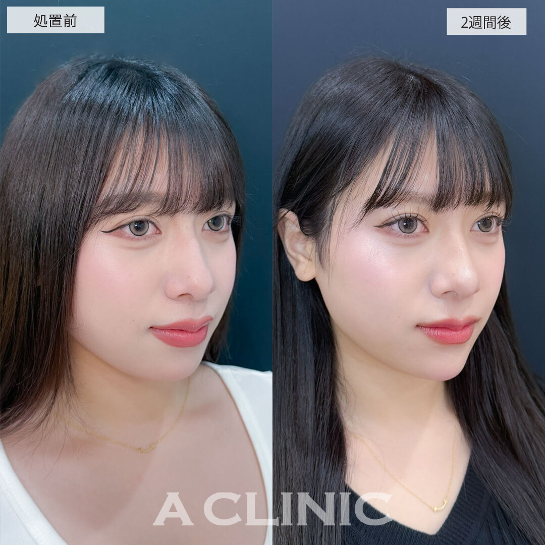 ヒアルロン酸カスタマイズメニューでどの角度からのお写真もより可愛くなりました！こちら処置前と2週間後の症例です(20代女性)
