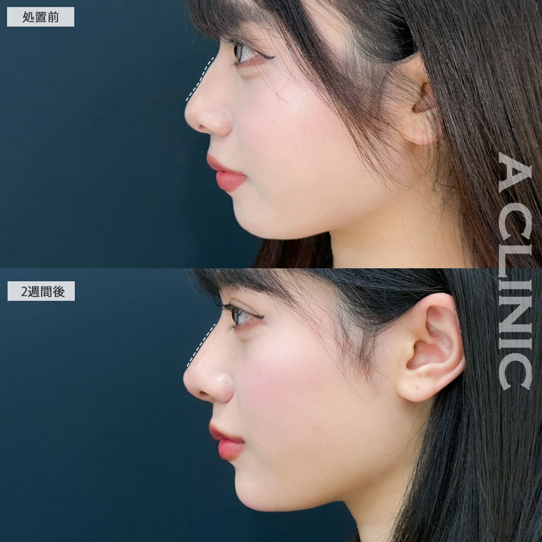 ヒアルロン酸カスタマイズメニューでどの角度からのお写真もより可愛くなりました！こちら処置前と2週間後の症例です(20代女性)
