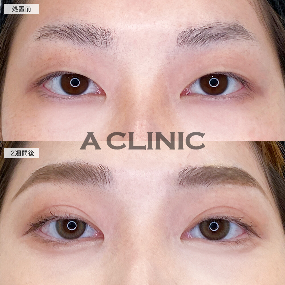 ドーリーアイズで理想の末広二重と涙袋になれました！処置前と2週間後の症例です(20代女性)